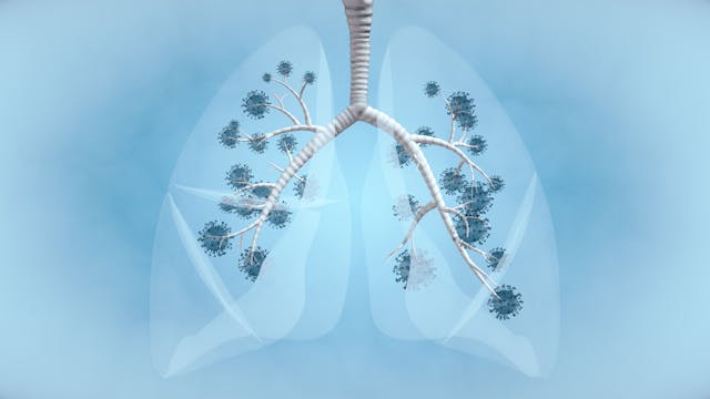 Image of lung cancer in both lungs.