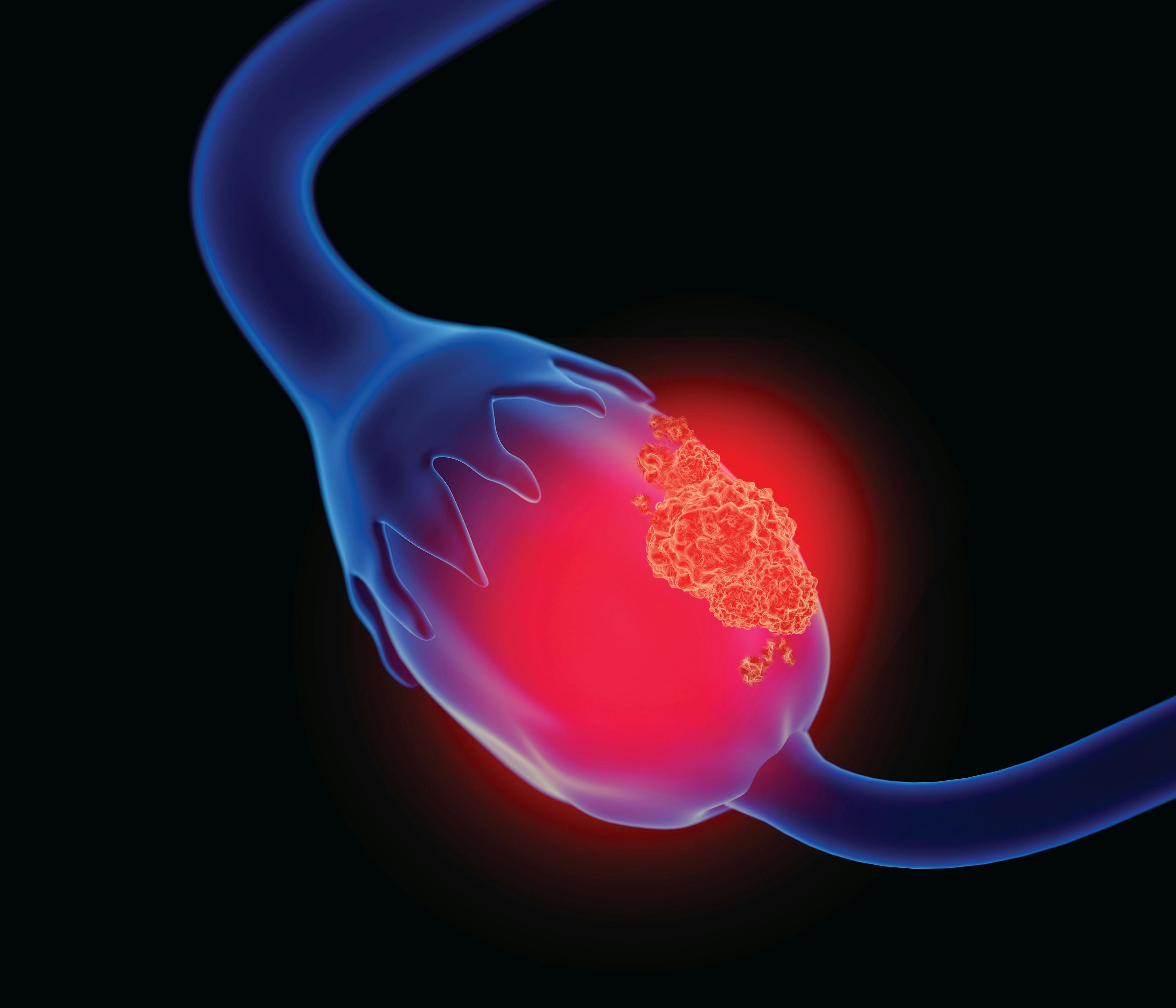 Do I Have Ovarian Cancer? Understanding the Early Signs, Detection and Treatment