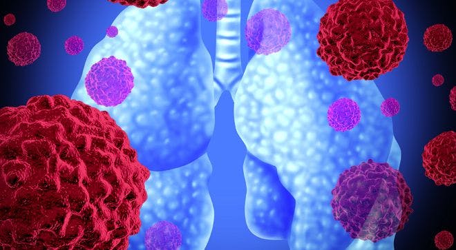 Immunotherapy Slows Limited Metastatic Non-Small Cell Lung Cancer After Surgery or Radiation