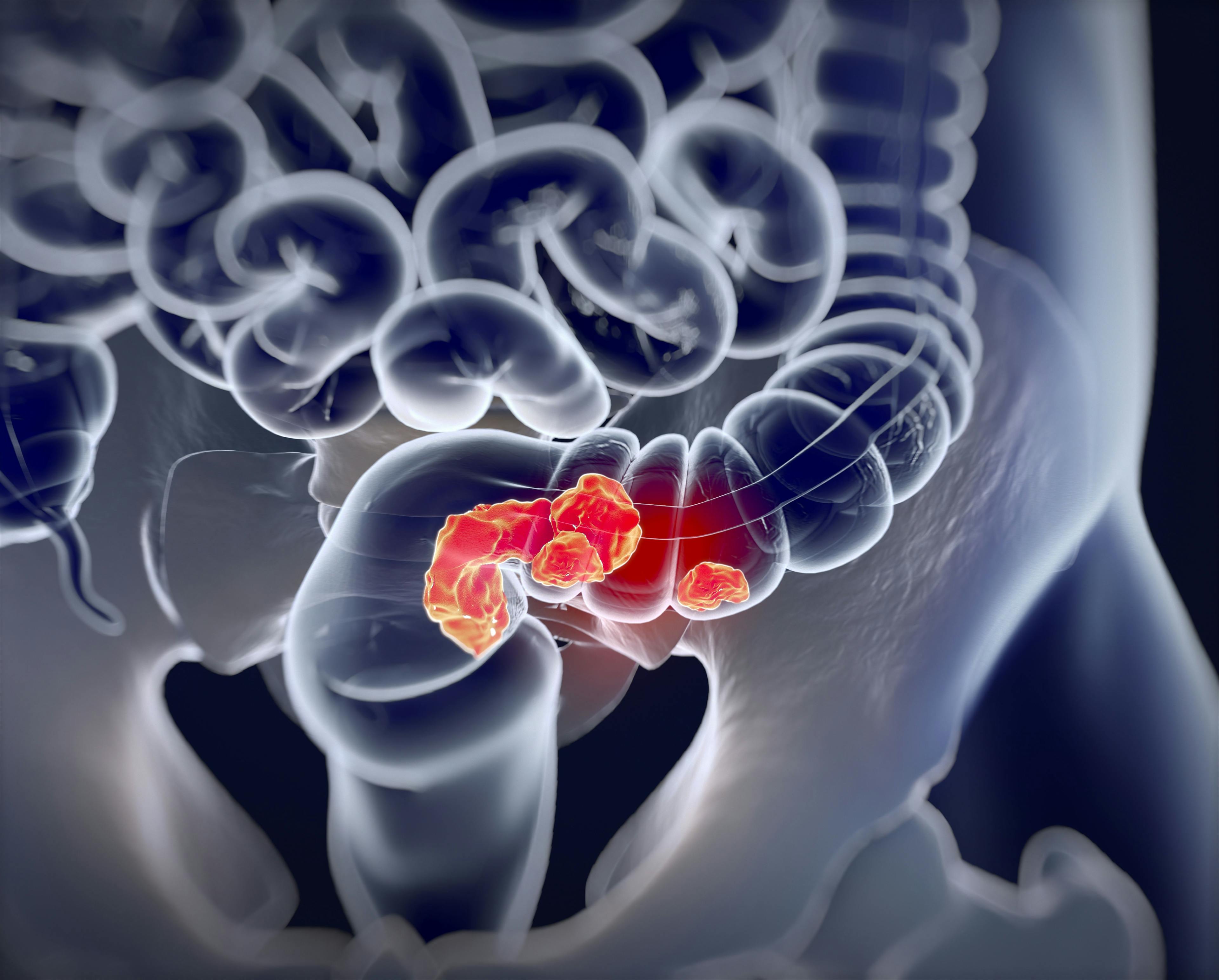 Early-Onset Colorectal Cancer Is Not Distinguishable From Average-Onset CRC