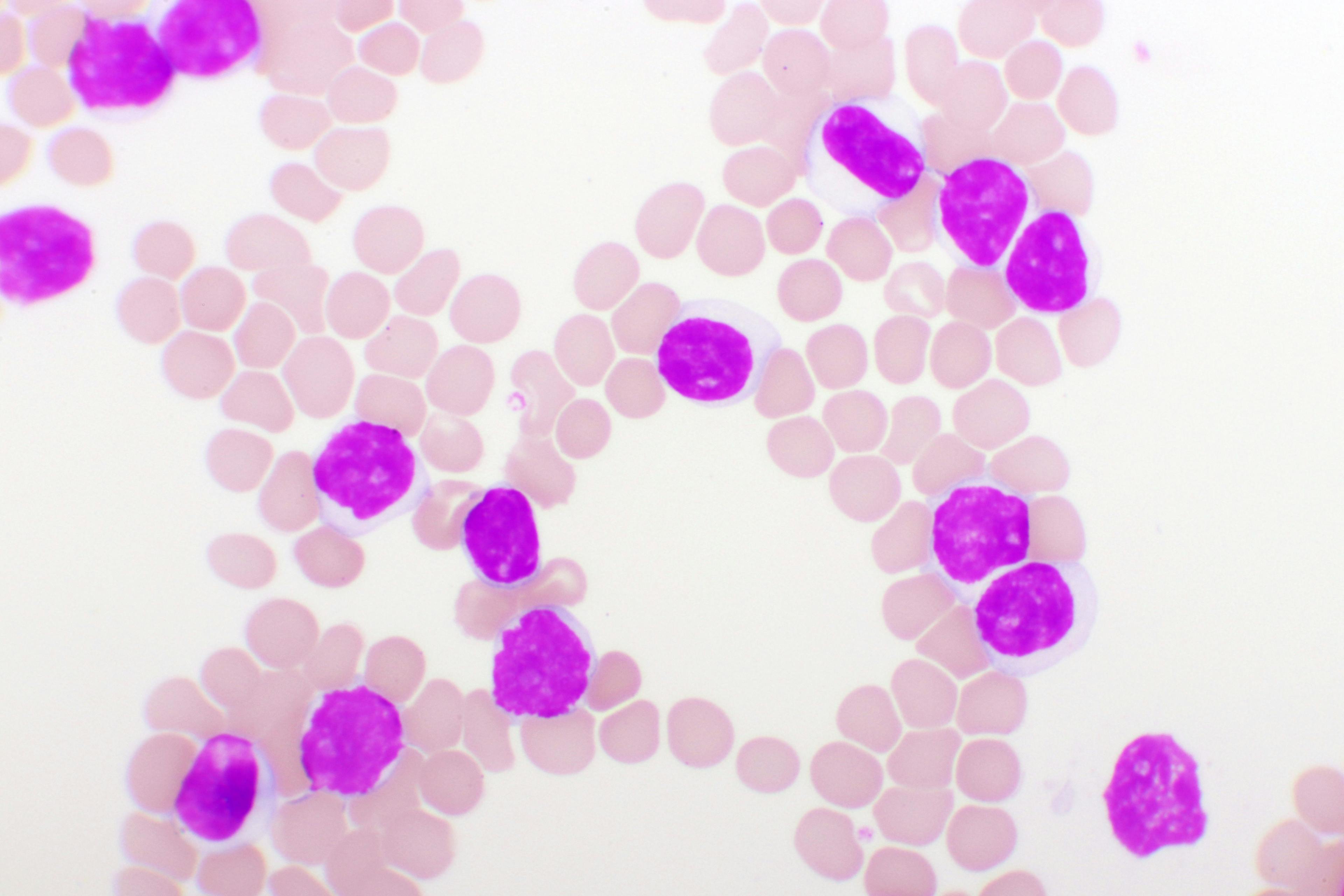 Adding to the Regimen: NCCN Updates in Leukemia and Lymphoma