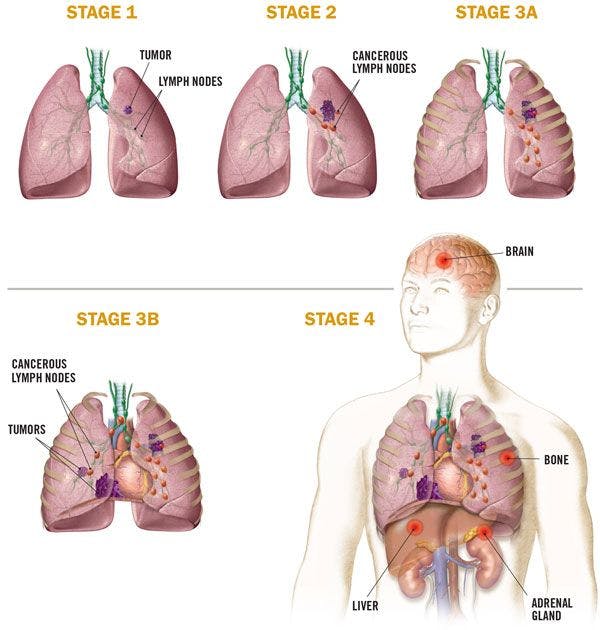Following a lung cancer diagnosis, staging determines the best options for treatment. Many factors are evaluated, including the size of the tumor and the extent of spread.