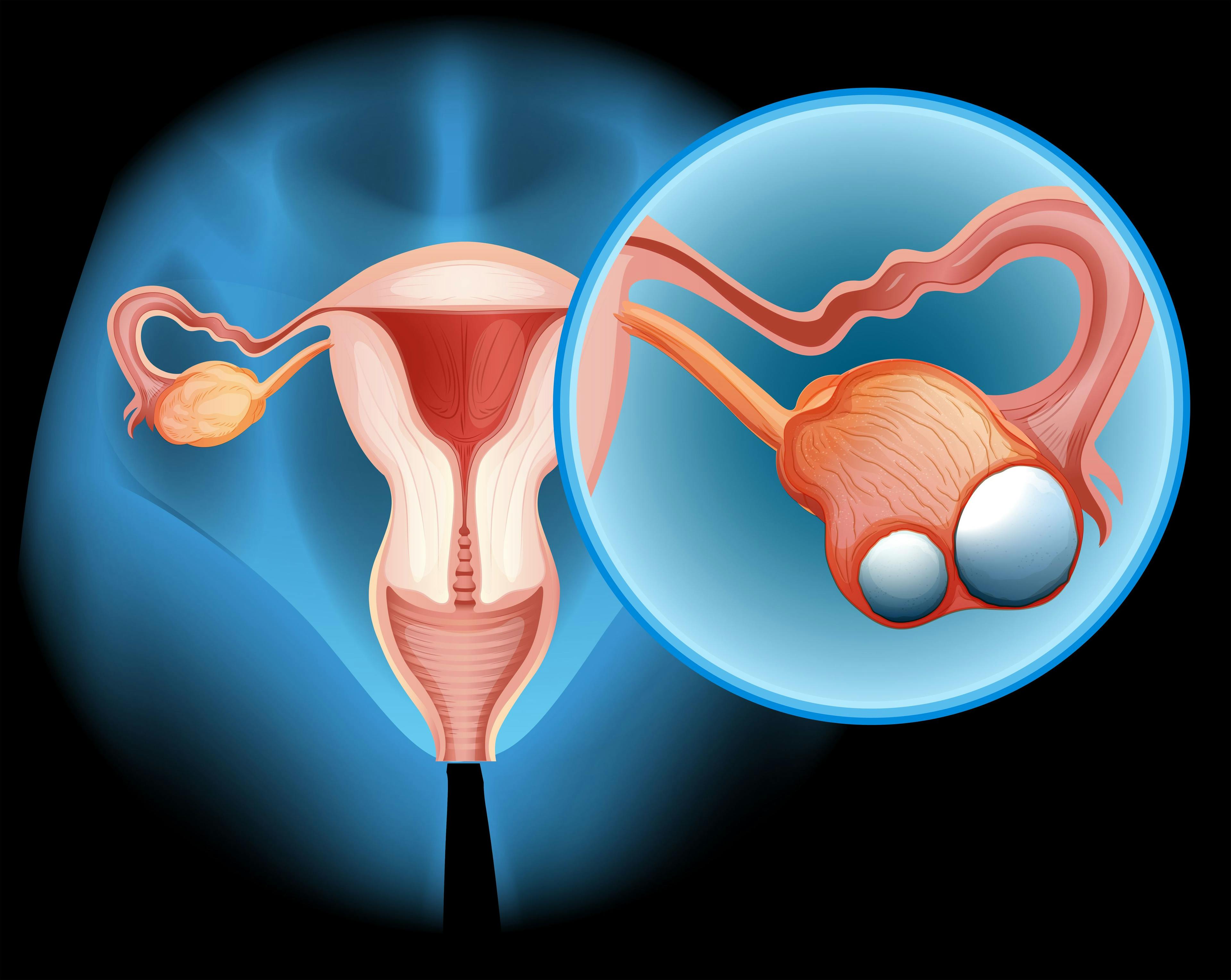 reproductive organs with ovaries highlighted with visible cancer