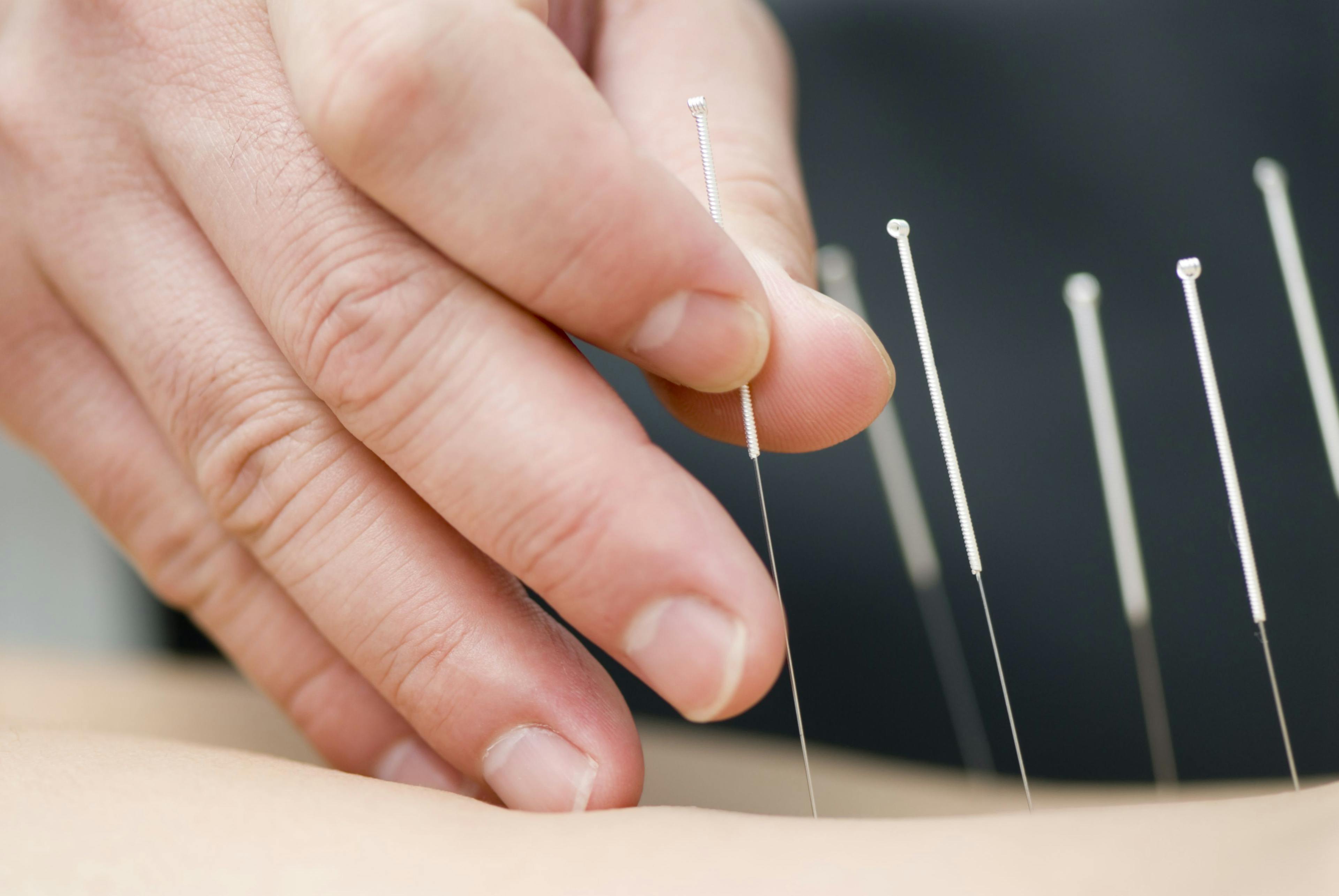 acupuncture needles being place in a person's back