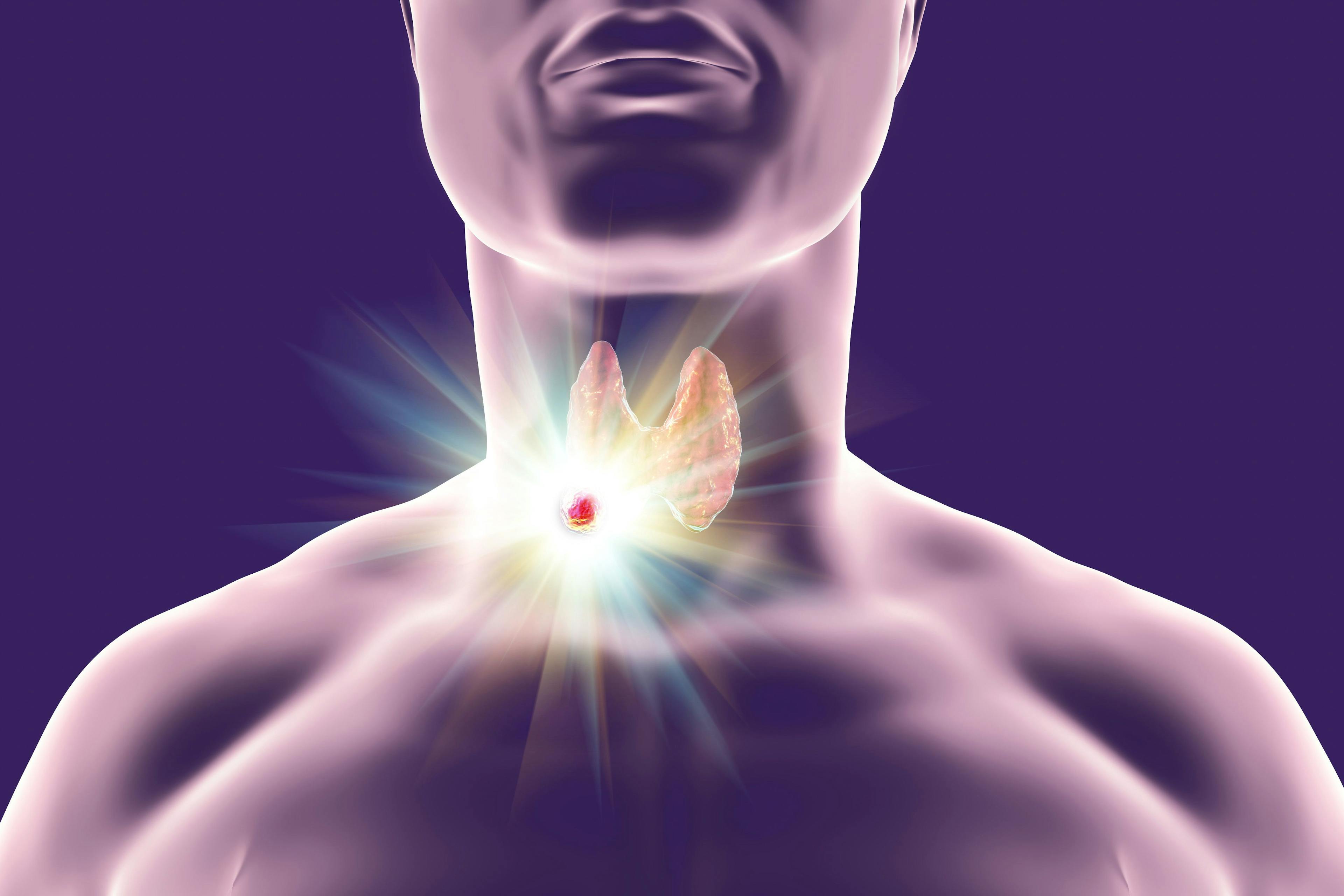 present tumor in thyroid