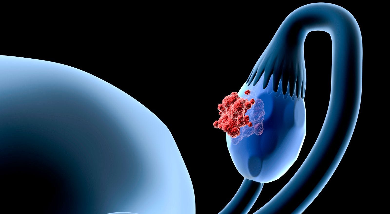 PARP Inhibitors Continue to Show Promise in Ovarian Cancer