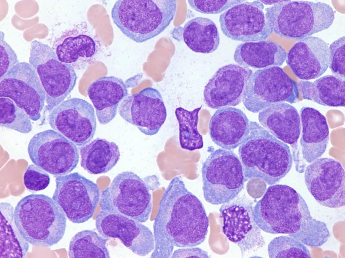 Image of leukemia in the body with cells.