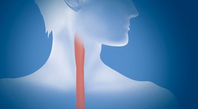 Keytruda Approved to Treat Advanced Esophageal Cancer: What You Need to Know