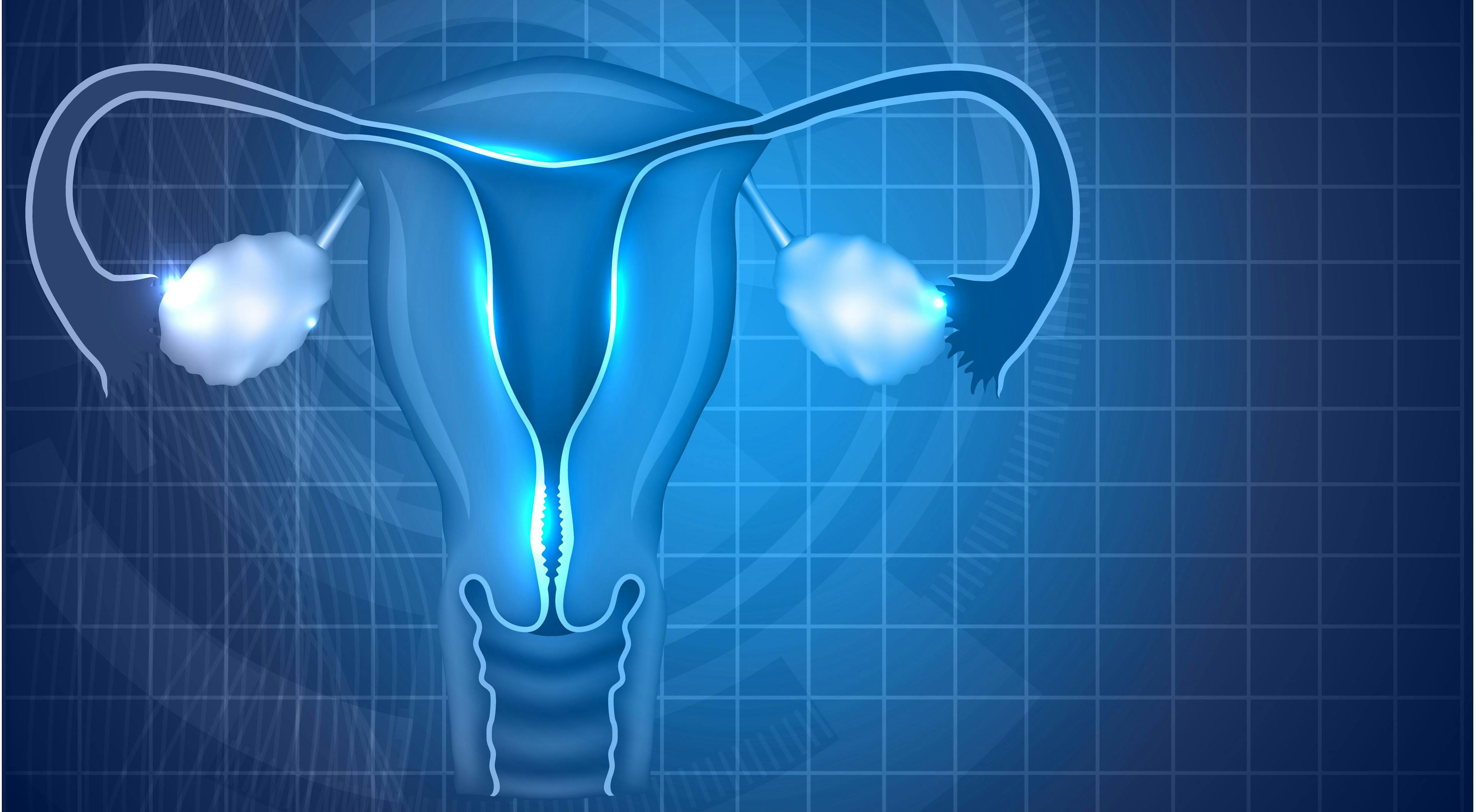 Lymphadenectomy Didn’t Improve Progression, Survival in Ovarian Cancer