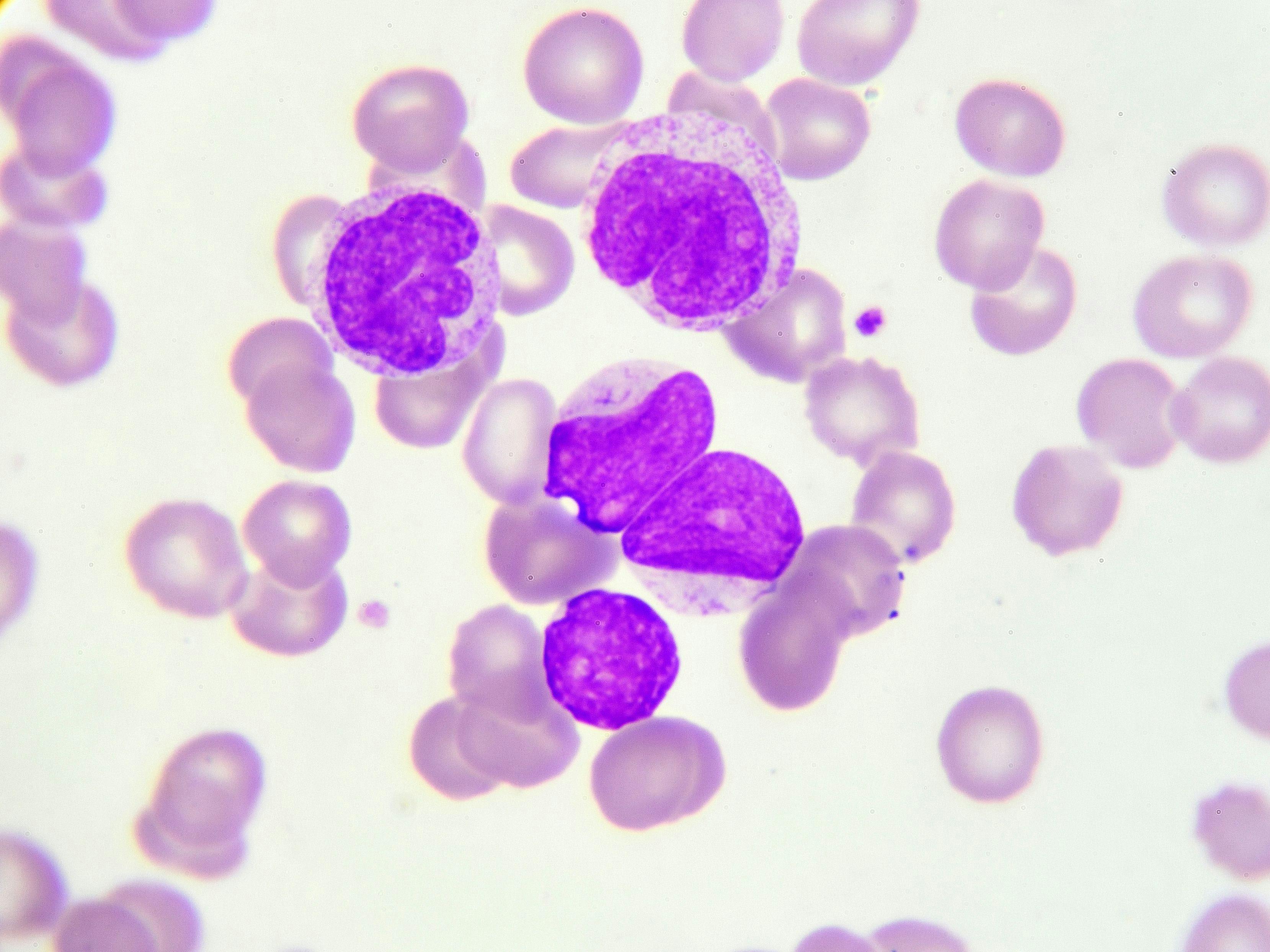 Drug Conjugate Designed to Deliver Iodine-131 Shows Promise in Triple-Refractory Multiple Myeloma
