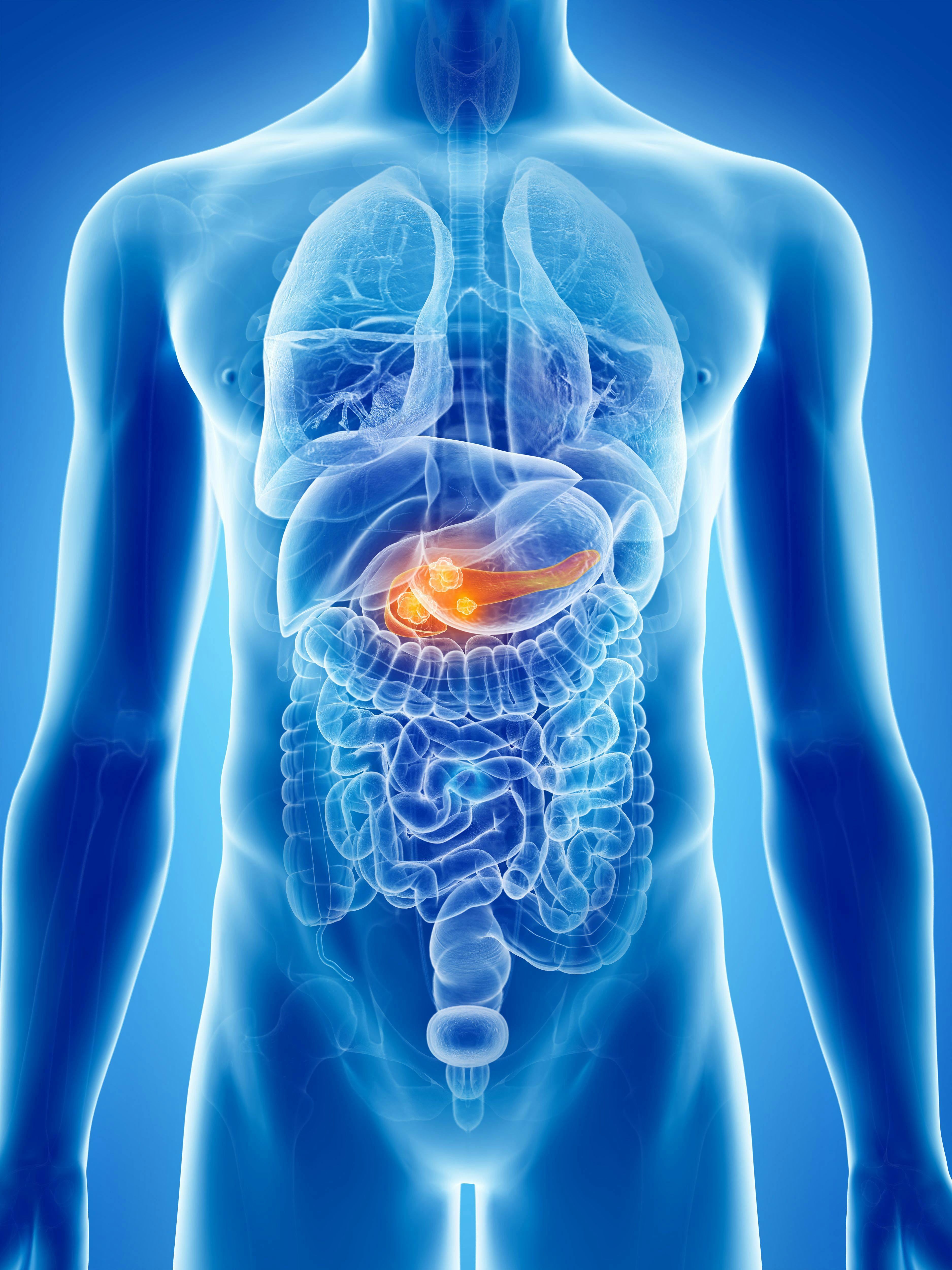 Phase 1 Trial Begins for New Treatment Delivery Strategy in Pancreatic Cancer