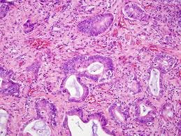 Image of small cell lung cancer.