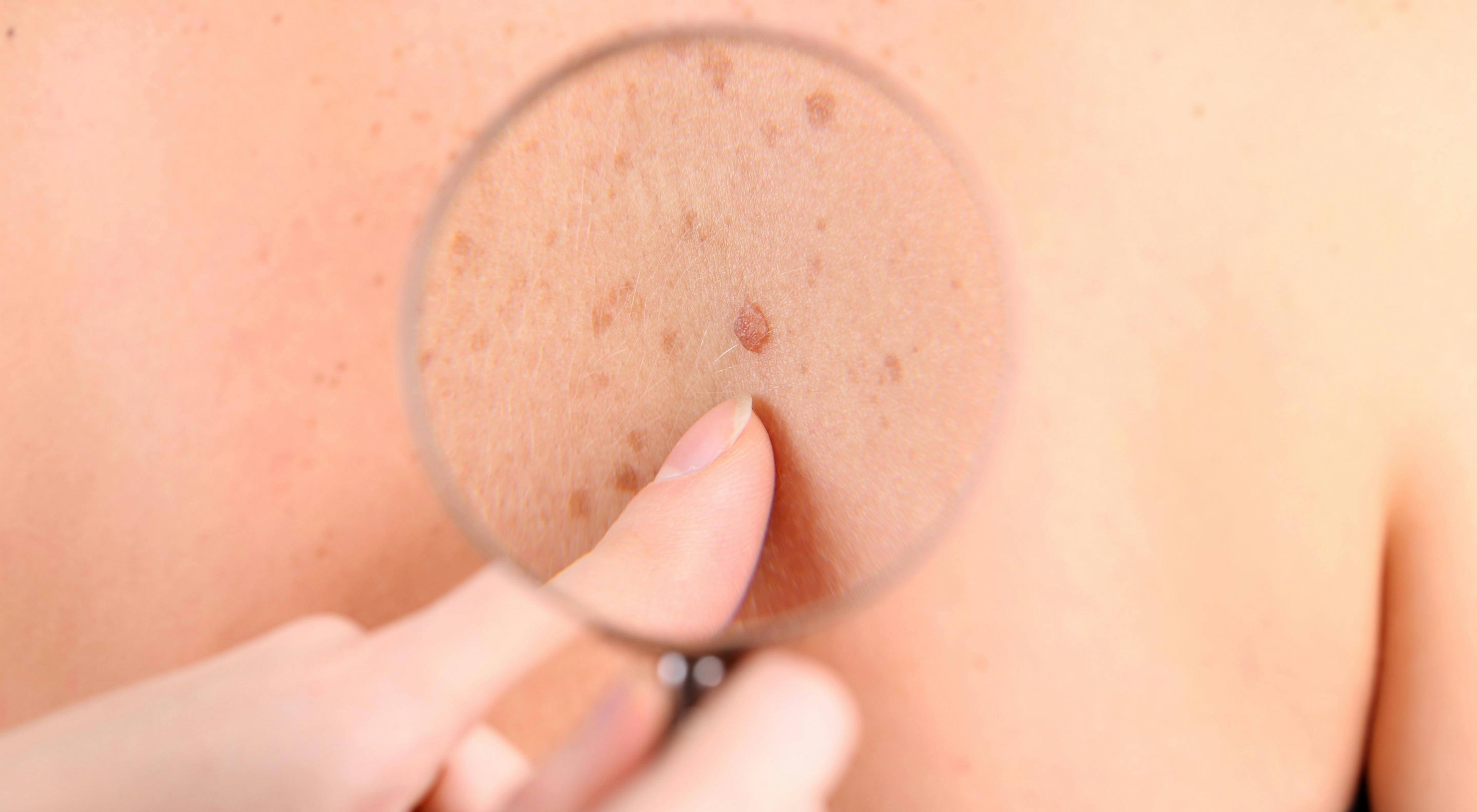 Visible Melanoma Lesions Affect Patients' Physical, Emotional Quality of Life