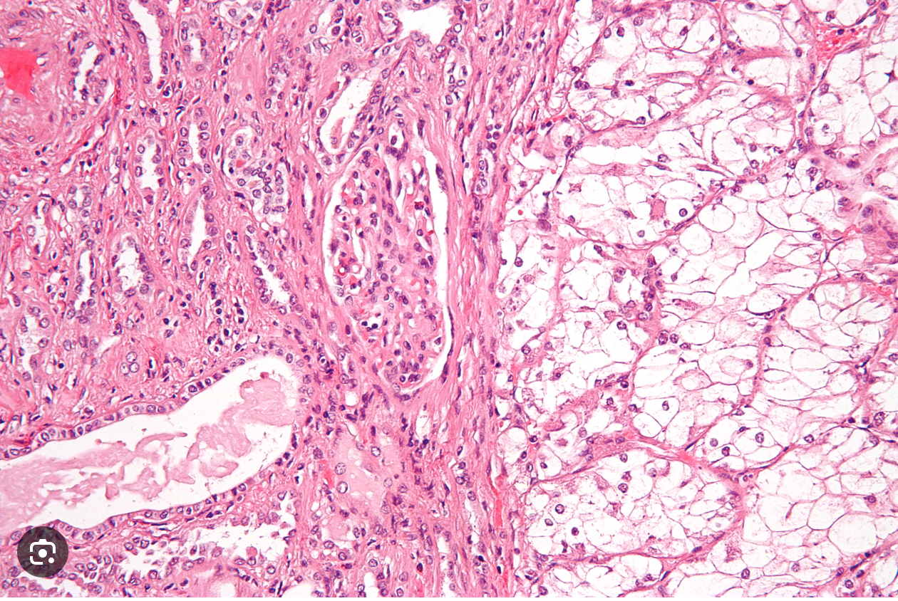 image of clear cell renal cell carcinoma