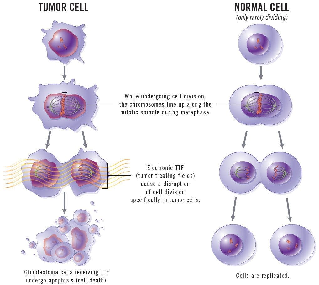 How Tumor-Treating Fields Work