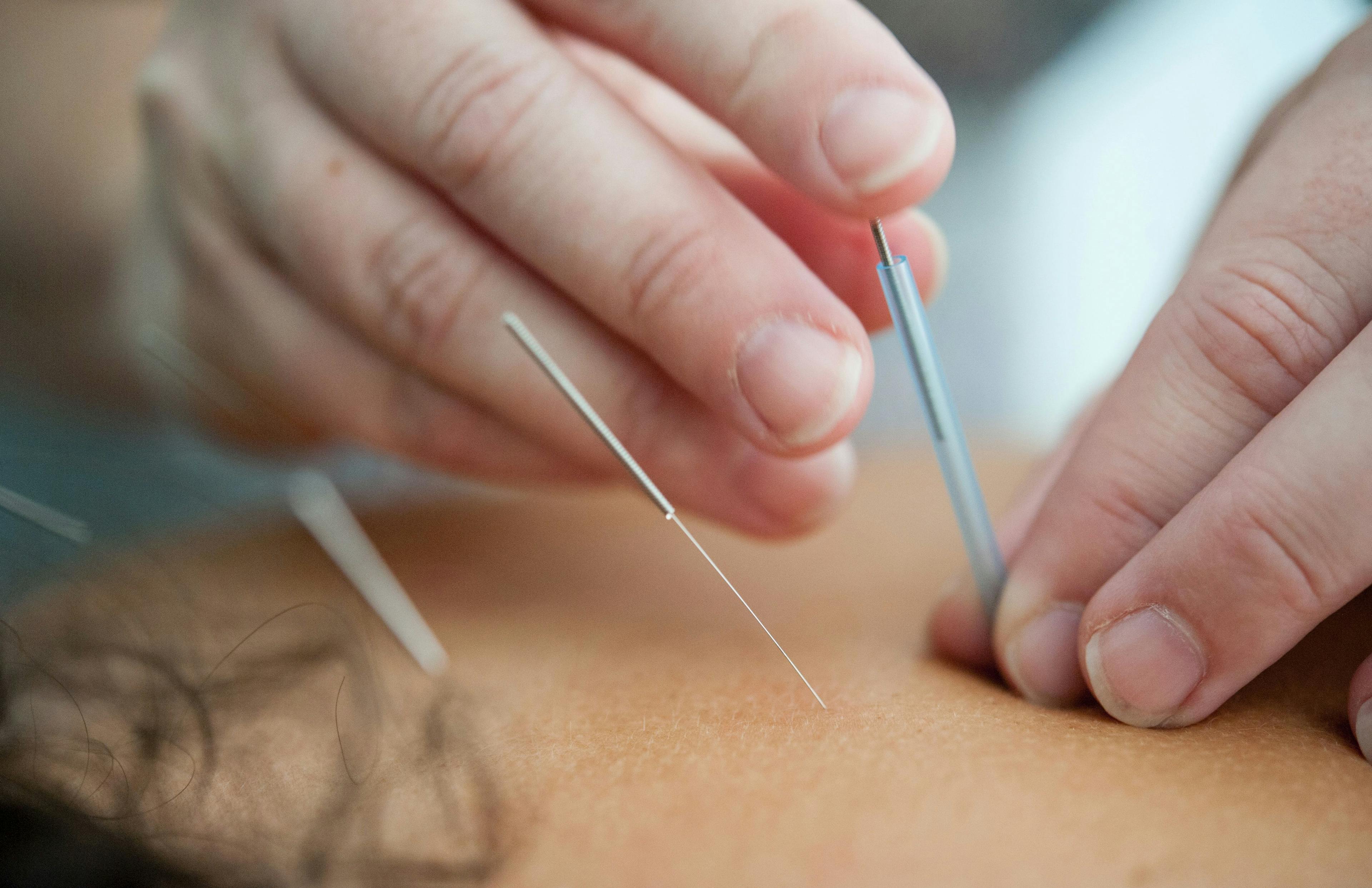 Acupuncture May Reduce Pain Levels in Patients with Breast Cancer
