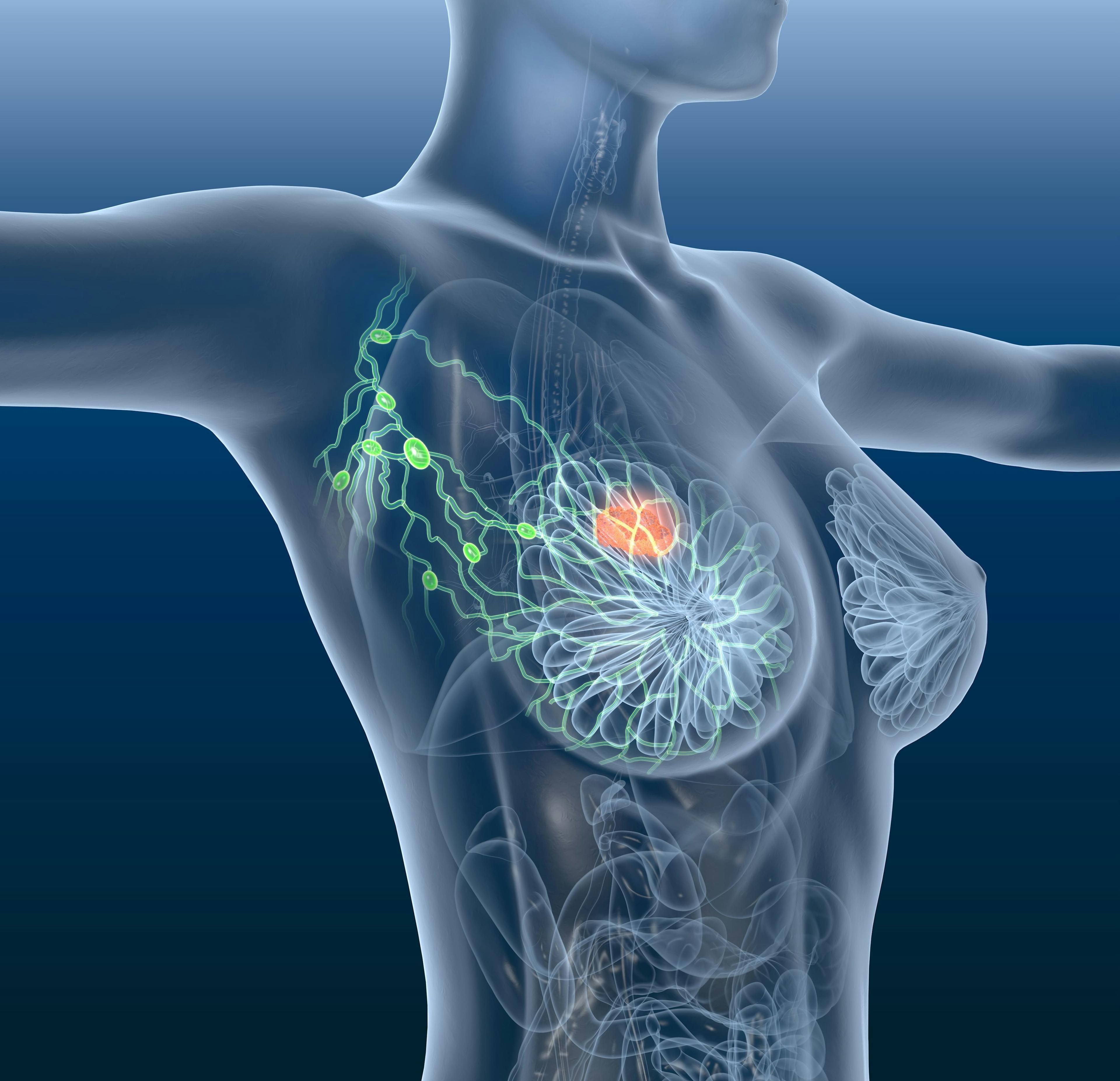 Enhertu Outperforms Chemotherapy in HER2-Low Unresectable/Metastatic Breast Cancer
