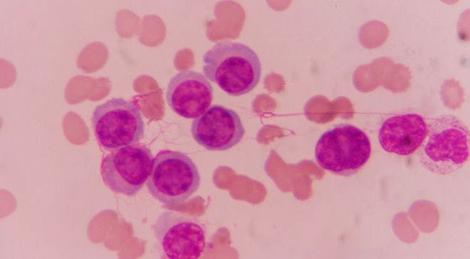 Front-line Combinations with New Agents Evolve Chronic Lymphocytic Leukemia Landscape