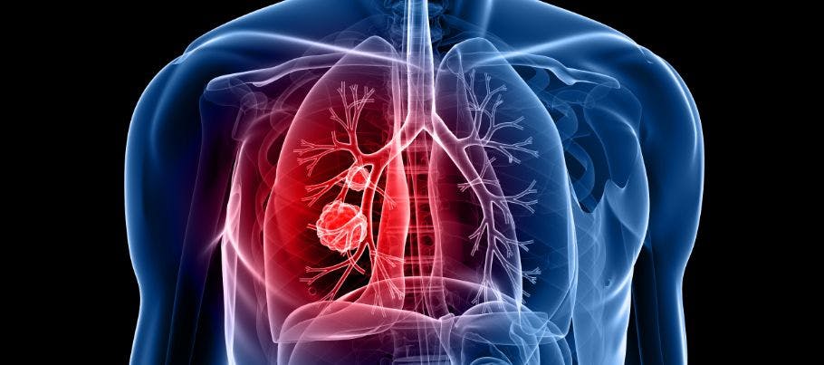 Imaging of a body with lungs highlighted to indicate advanced lung cancer.