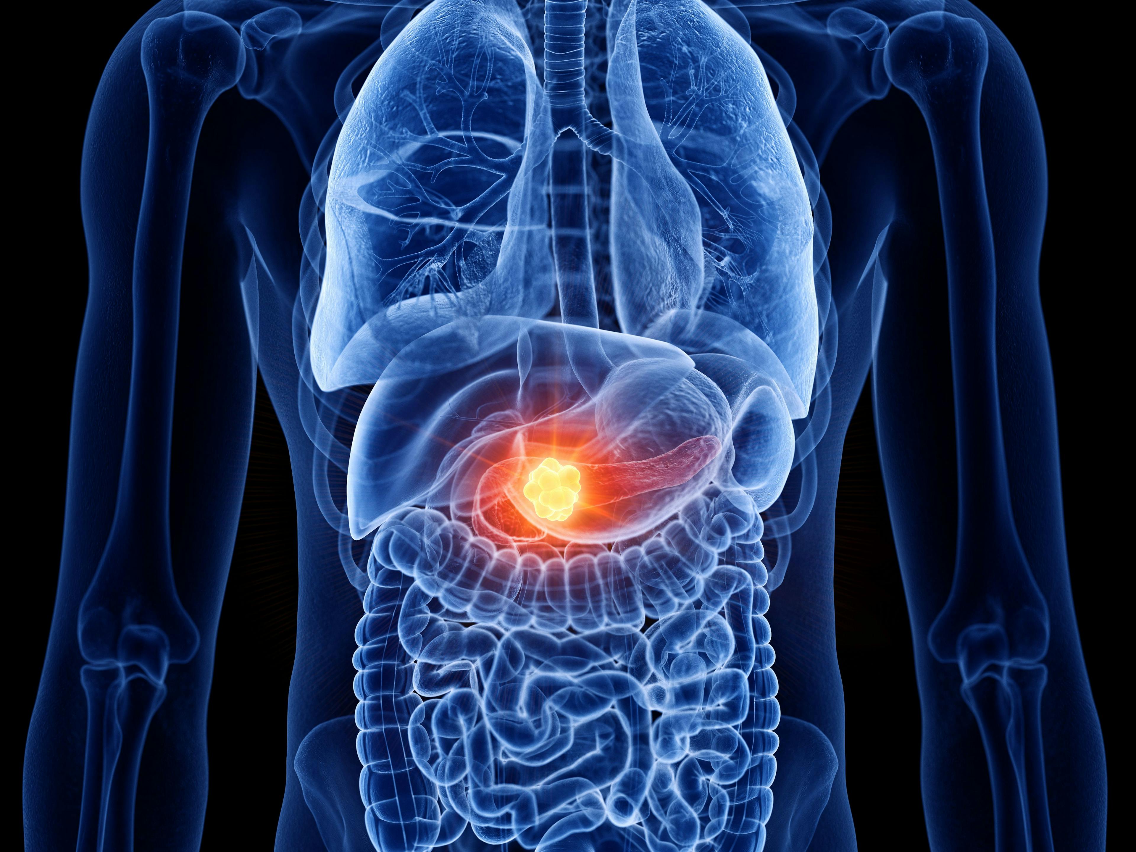 3d rendered medically accurate illustration of pancreas cancer | Image credit: SciePro - © stock.adobe.com