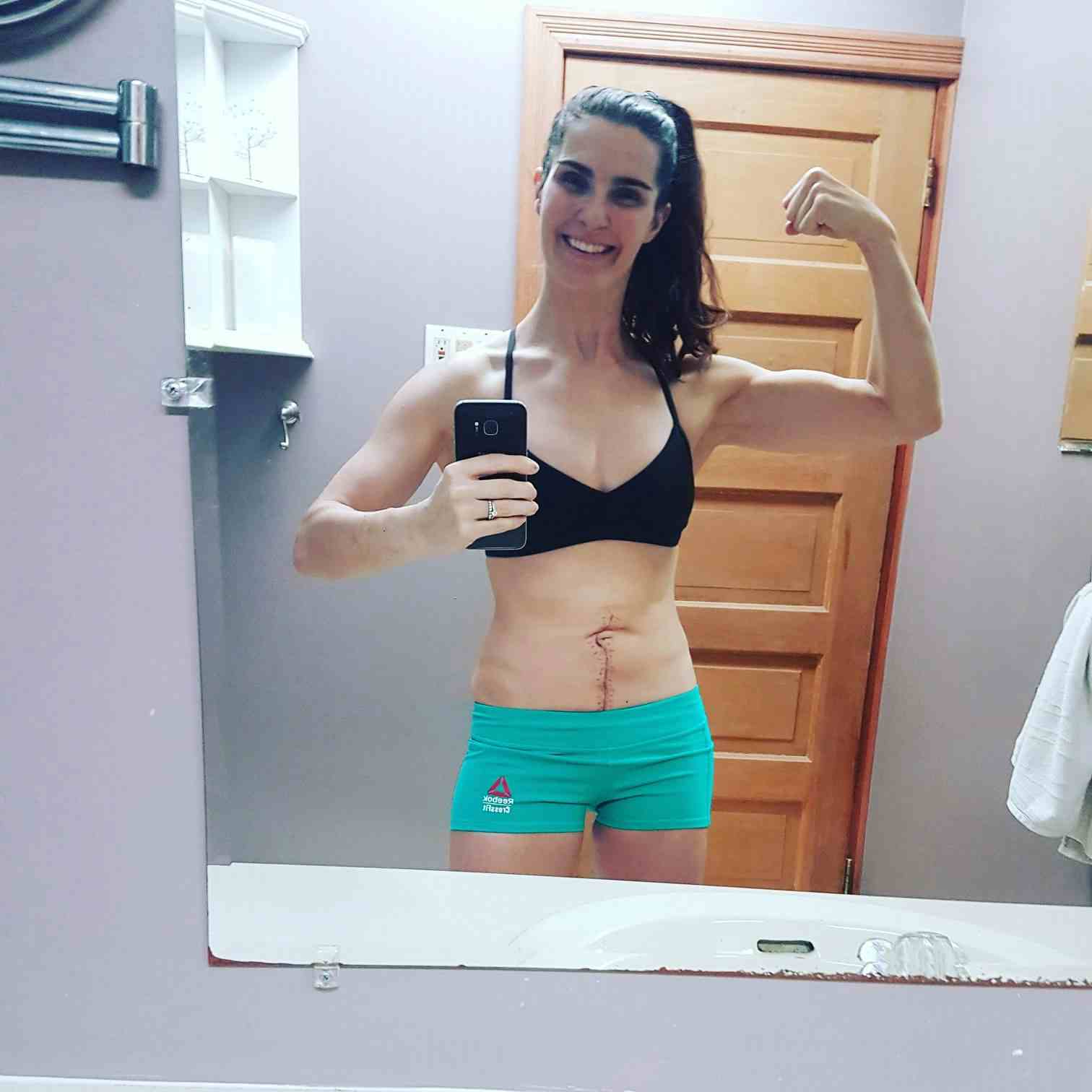 Jennifer Broxterman smiling and making a muscle, showing off her abdominal scar after cancer surgery
