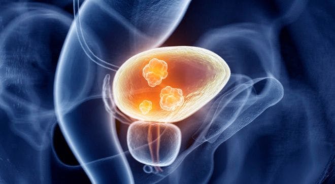 First Patient Dosed in Early-Phase Trial Investigating a New Drug for Bladder Cancer