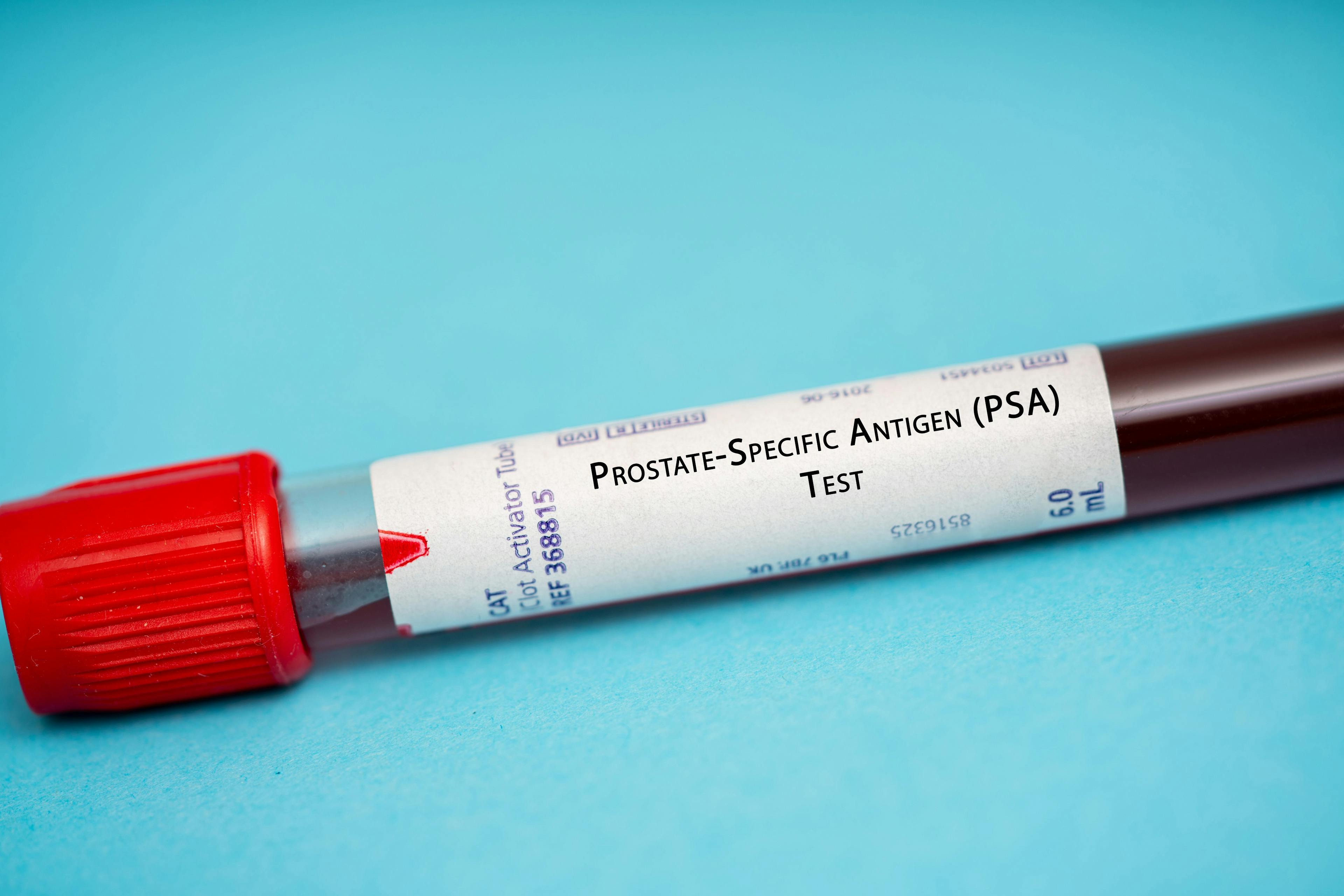 blood sample in test tube labeled "prostate-specific antigen"