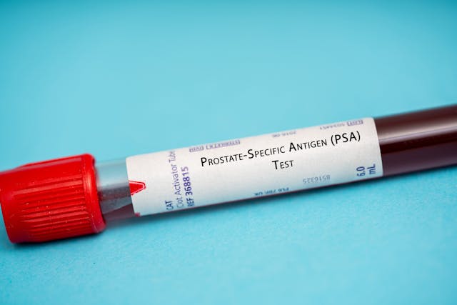 prostate-specific antigen (PSA) test | Image credit: © luchschenF - © stock.adobe.com