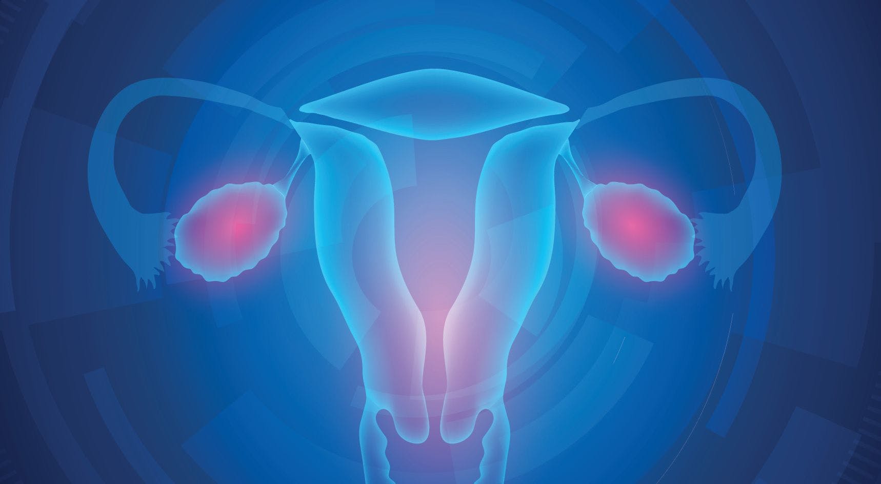 Lynparza Significantly Delays Progression in Advanced Ovarian Cancer, Study Finds