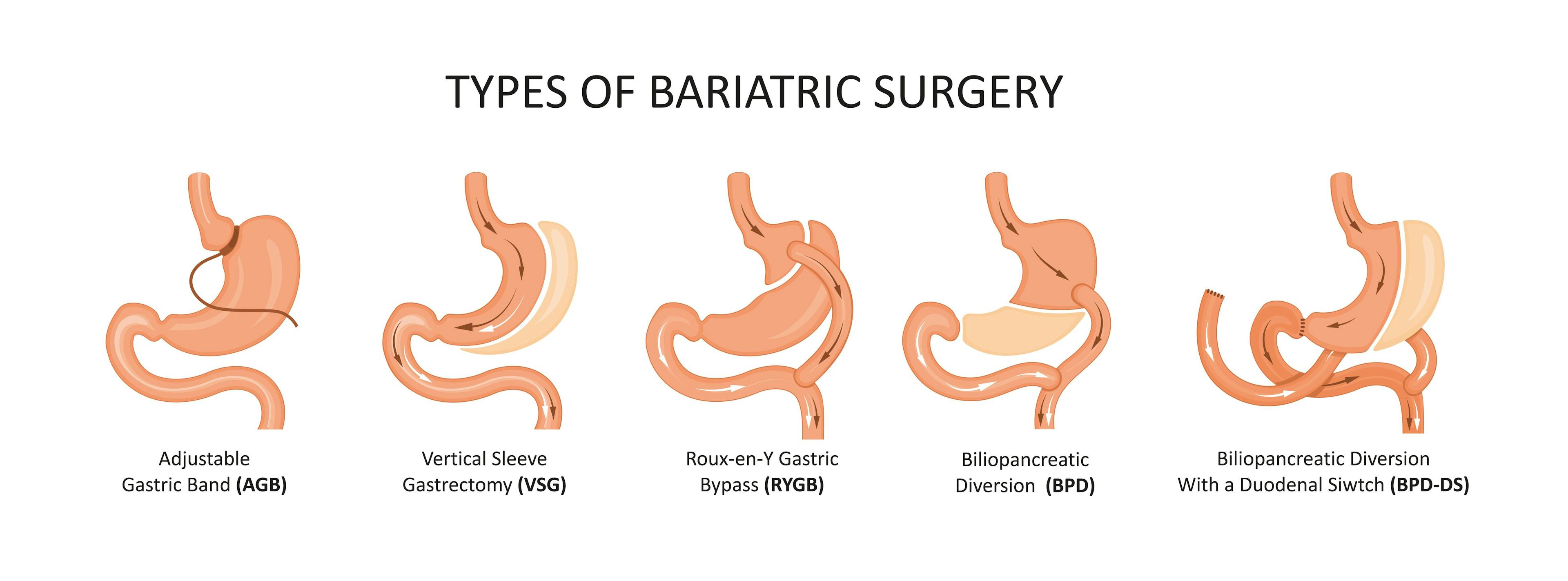Types of bariatric surgery. Stomach reduction | Image credit: © nmfotograf - © stock.adobe.com