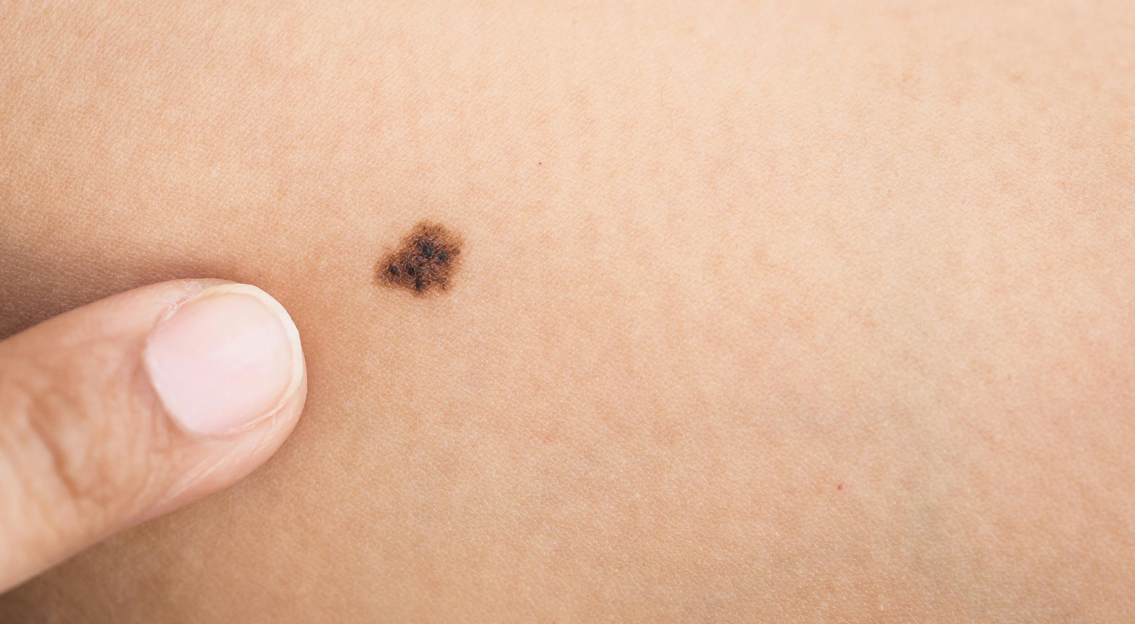 Patients and Caregivers Are on the 'Frontline' of Melanoma Monitoring 
