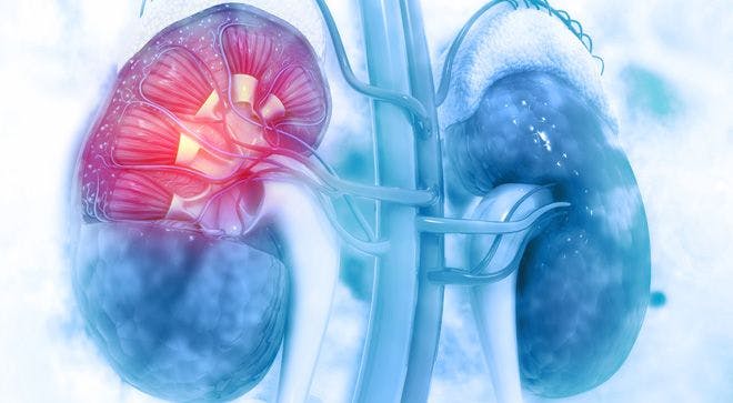 VHL disease-associated kidney cancer can occur early, (such as when patients are in their) 20s to 30s and is often multifocal and in both kidneys, according to an expert at The University of Texas MD Anderson Cancer Center in Houston. 