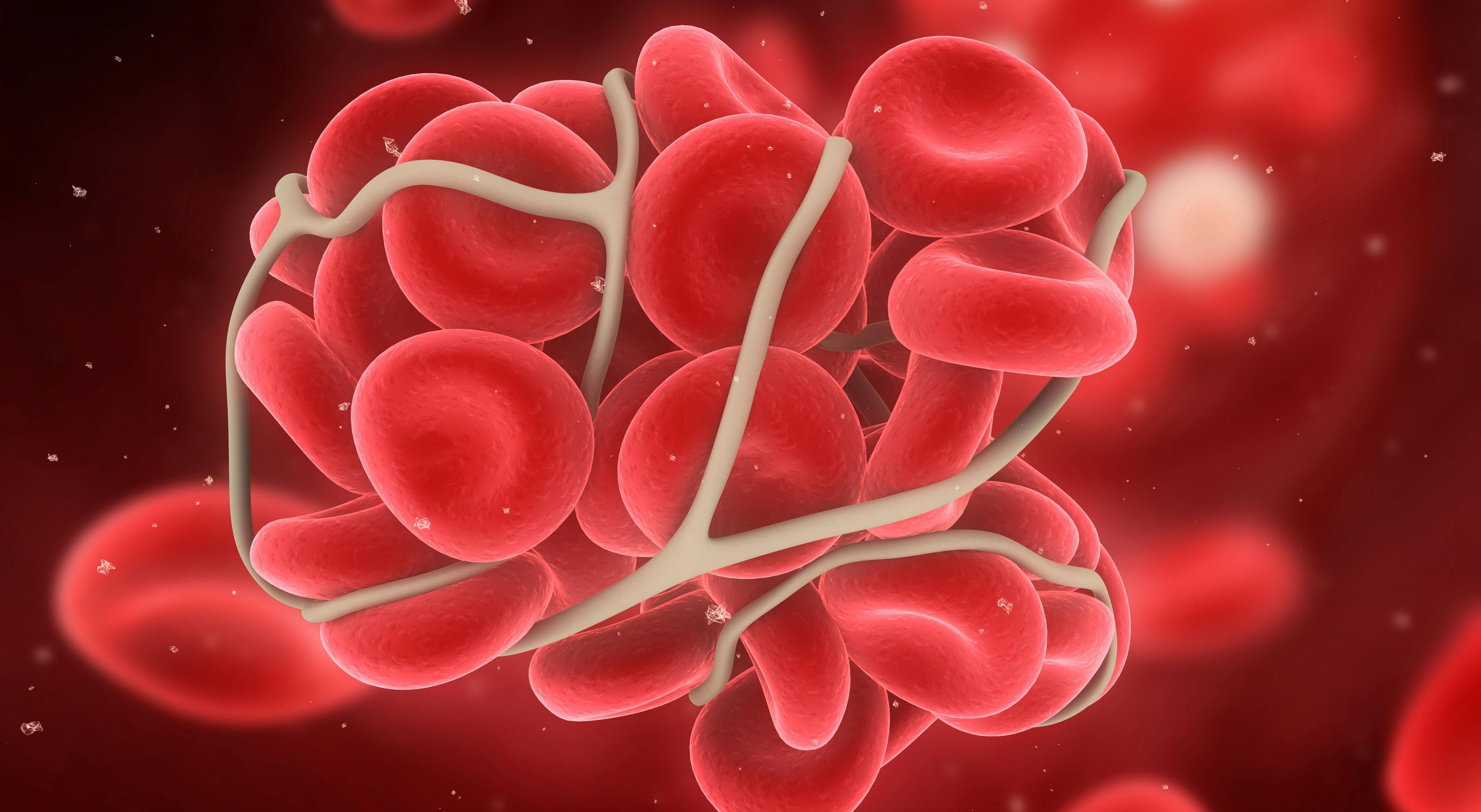 Patients With Myeloproliferative Neoplasms May Have Increased Thrombosis Risk
