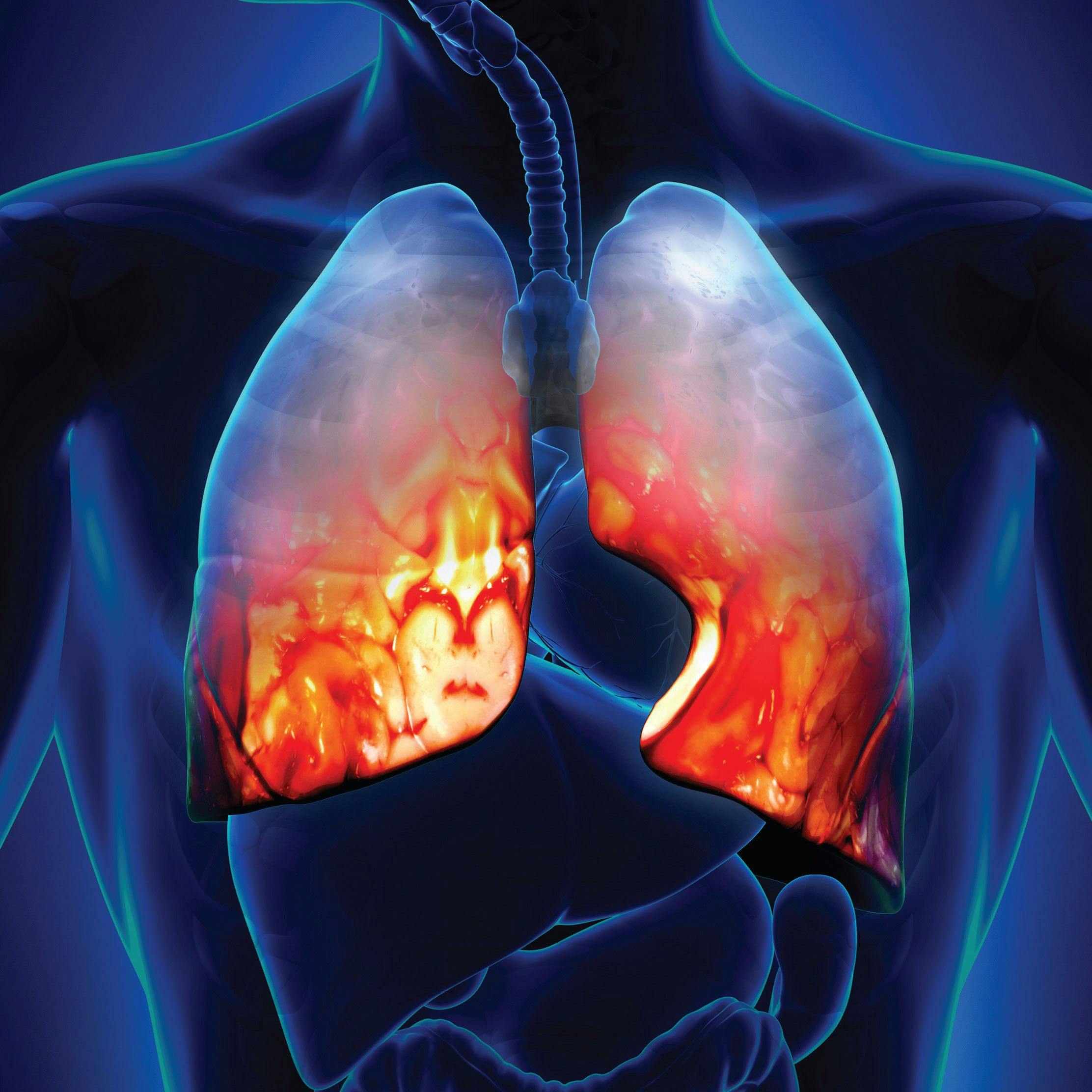 Nurse Perspective: Controlling Side Effects From Targeted Therapies for Lung Cancer
