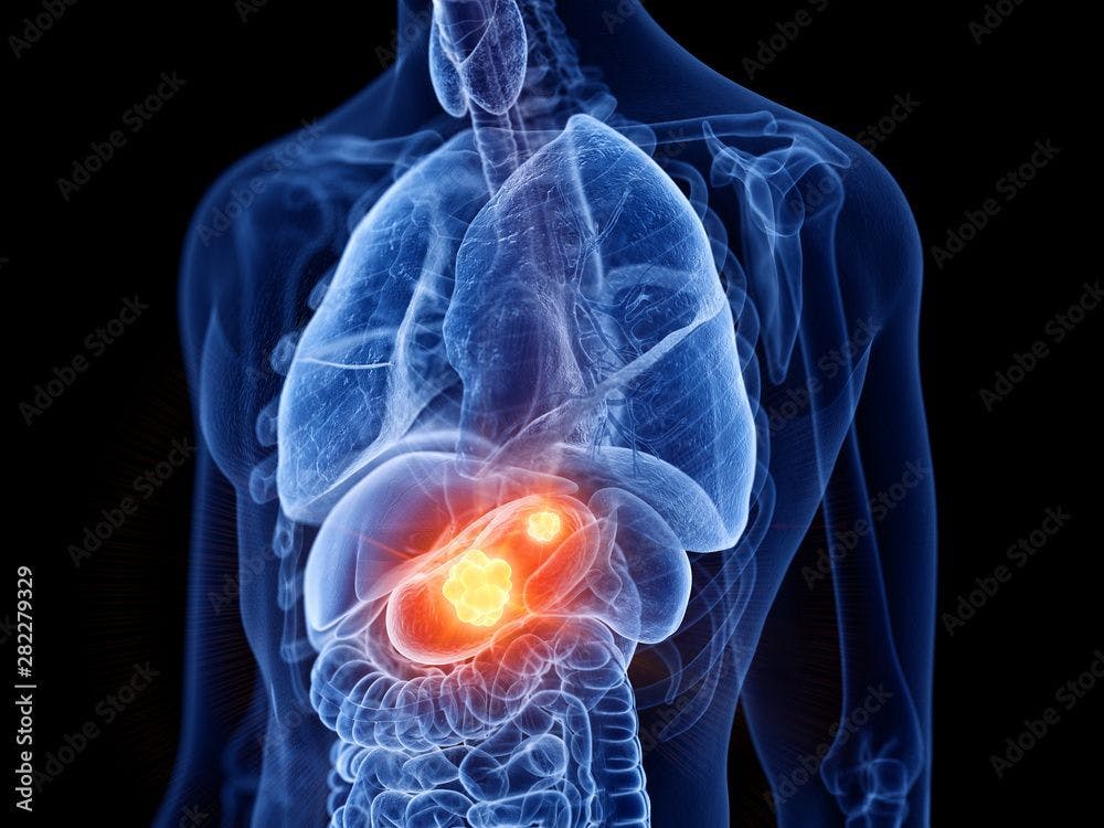 Vitrakvi continues to improve outcomes for patients with TRK fusion GI cancers; 3d rendered medically accurate illustration of stomach cancer | Image credit: © - SciePro © - stock.adobe.com. 