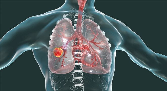 Medicaid Coverage Has No Discernible Impact on Survival in Small-Cell Lung Cancer