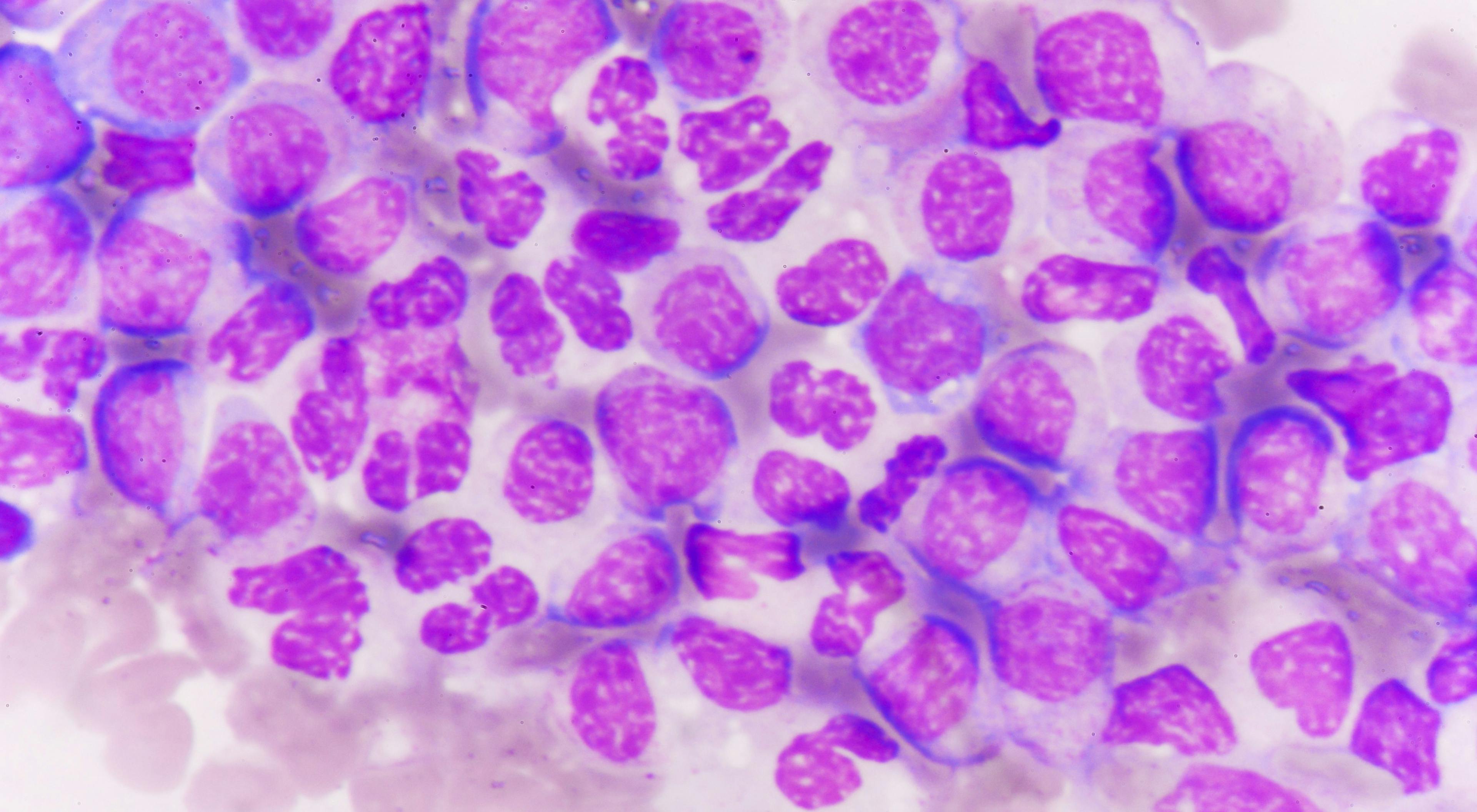 Encouraging Preliminary Results in Myelofibrosis Trial Lead to Enhancements in Phase 2