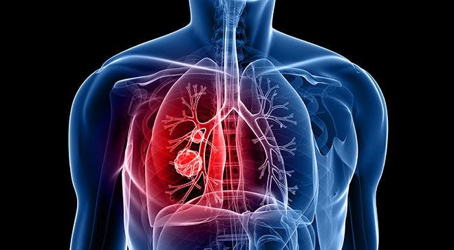 Changing the Sequence of Therapies Can Improve Results in NSCLC