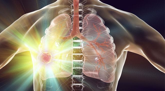 Artificial Intelligence May Reduce False Positives in Lung Cancer Screening