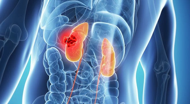 Understanding The Basics of VHL-Related Kidney Cancer