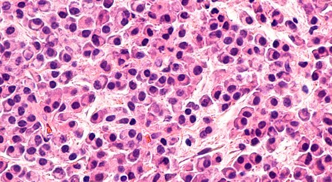 image of myeloma