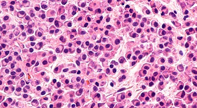 image of myeloma represented with colors of pink and purple.