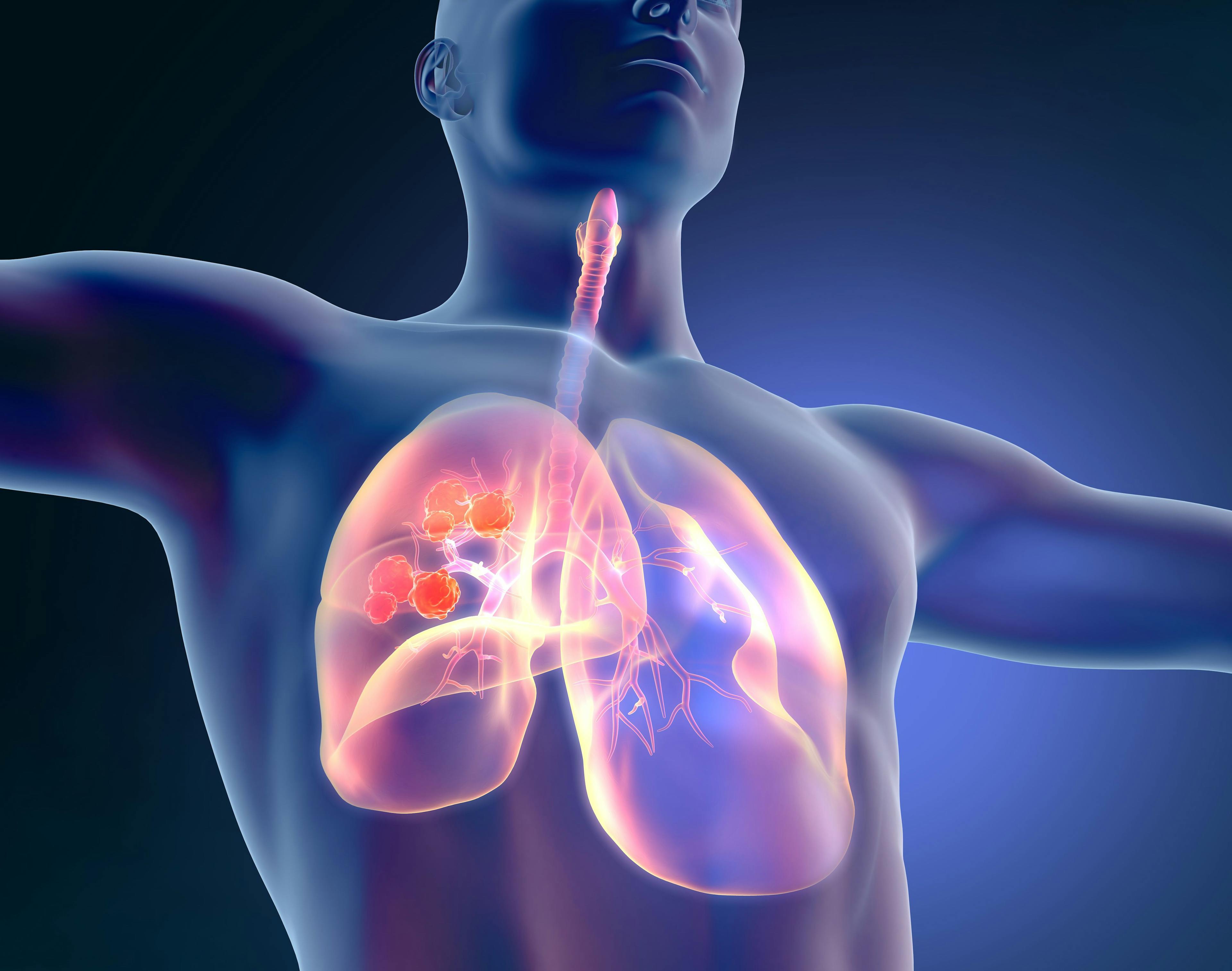 Novel Drug Bests Tagrisso in Heavily Pretreated Lung Cancer