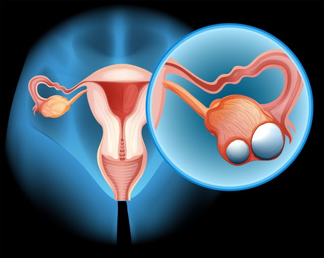 ovarian cancer image