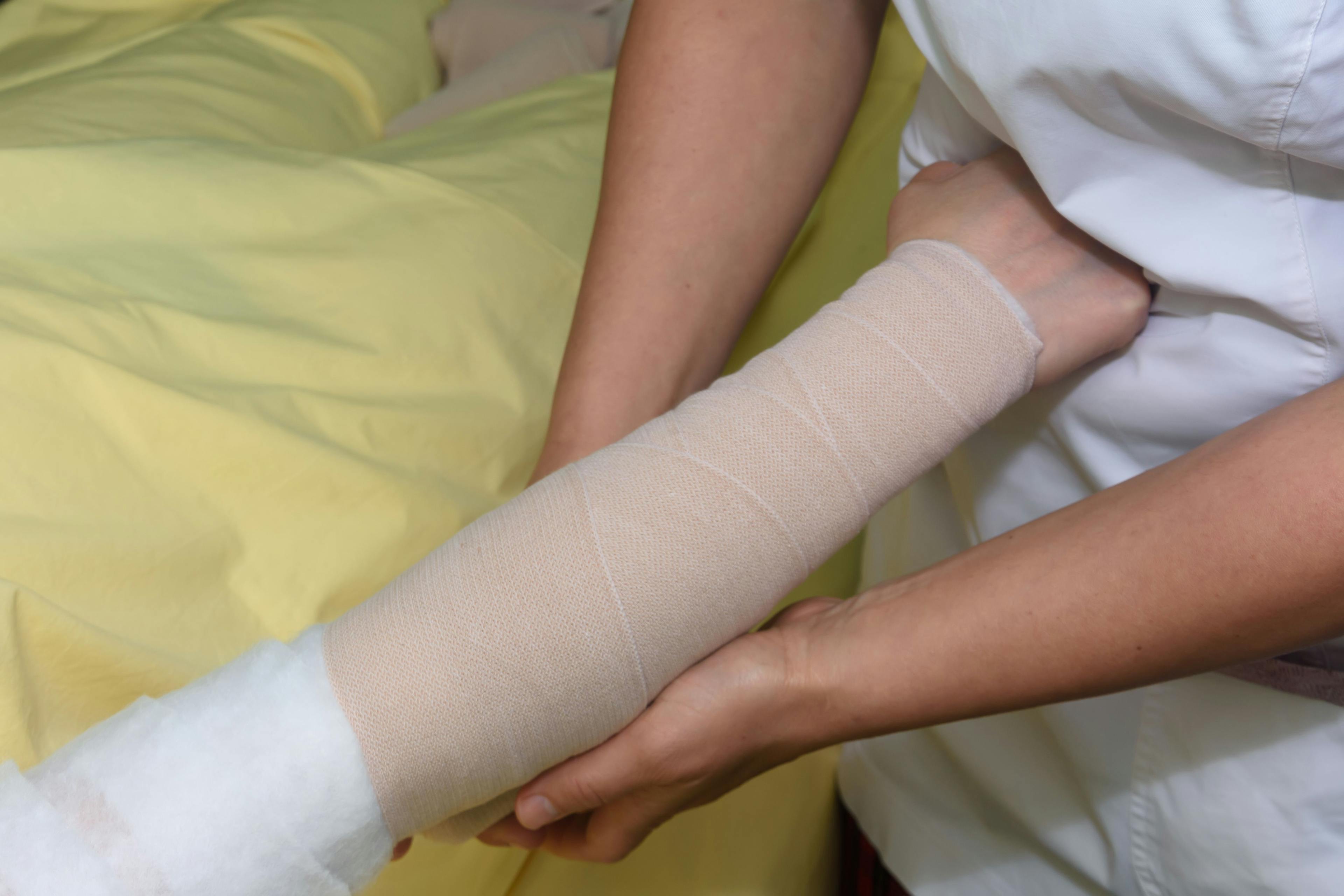 Lymphedema management: Wrapping Lymphedema Hand and Arm using multilayer bandages to control Lymphedema. Part of complete decongestive therapy (cdt) and manual lymphatic drainage (MLD)  | Image credit: © petiast - ©  stock.adobe.com