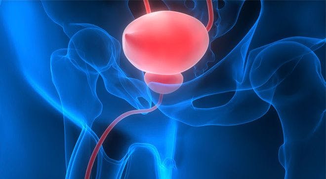Cabometyx Failed to Improve Survival in Advanced Bladder Cancer
