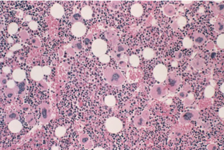 myelofibrosis image