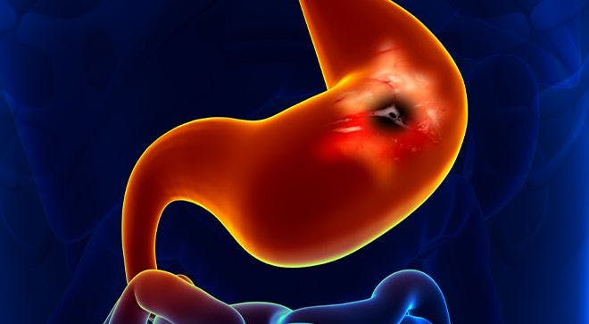 Image of black tumor in a red image of the stomach against a blue background 