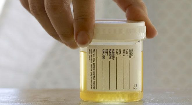 Highly Sensitive Urine Test Could Be a Better, Less Invasive Tool for Bladder Cancer