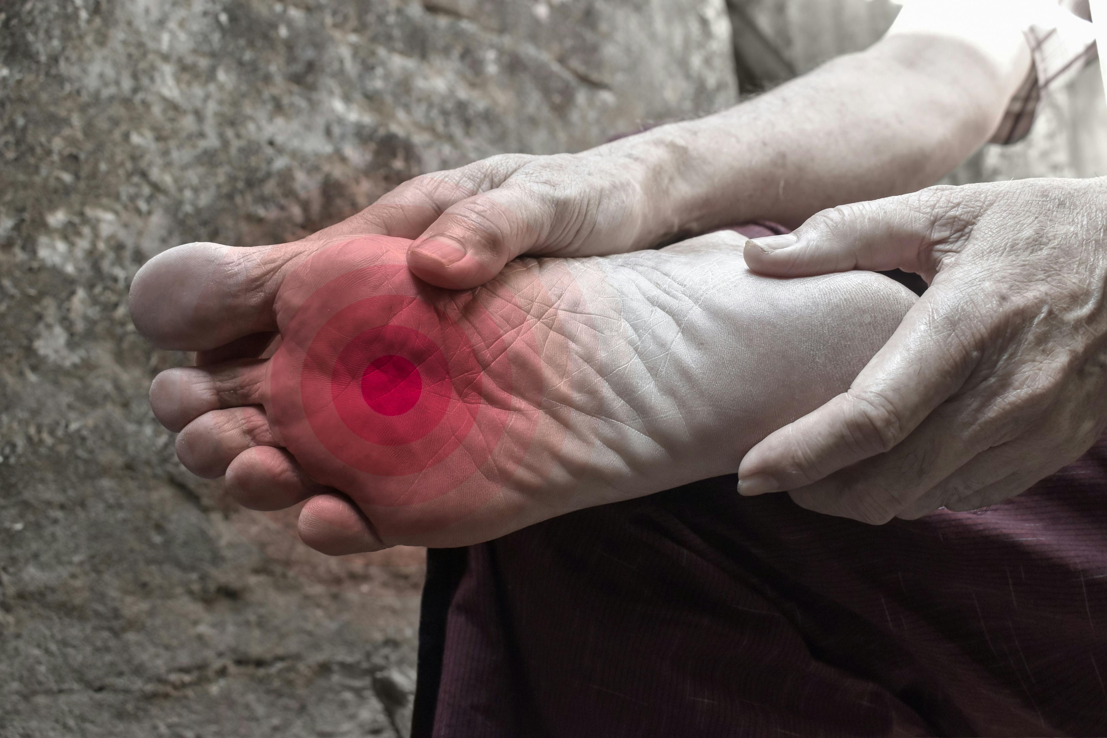 Tingling and burning sensation in foot of Asian man. Foot pain. Sensory neuropathy problems. Foot nerves problems. Plantar fasciitis. | Image credit: © ZayNyi - © stock.adobe.com